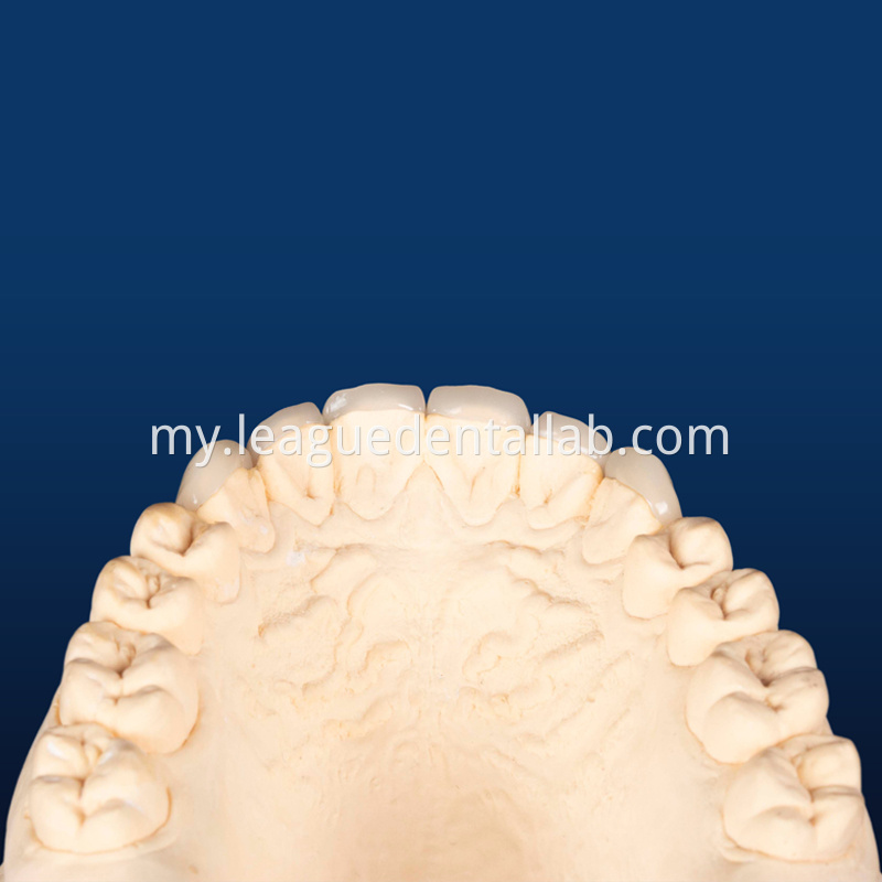 IPS Empress,Emax Onlay,Emax onlay,Emax Veneer,Lithium disilicate